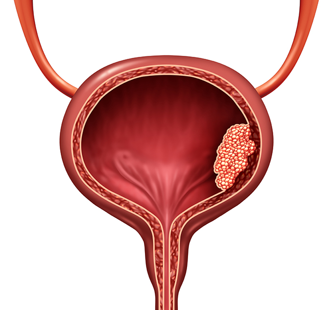 Human bladder cancer as a urinary anatomical organ disease and malignant cells concept as a 3D illustration cutaway of body anatomy.