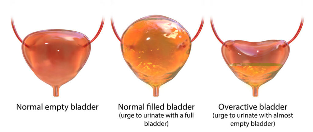 Illustration of: 1- normal empty bladder; 2- normal filled bladder (urge to urinate with a full bladder); 3- overactive bladder (urge to urinate with almost empty bladder)