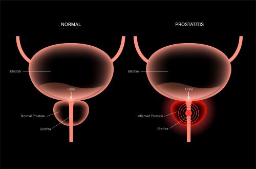 Diagram showing red rings around a illustrated prostate