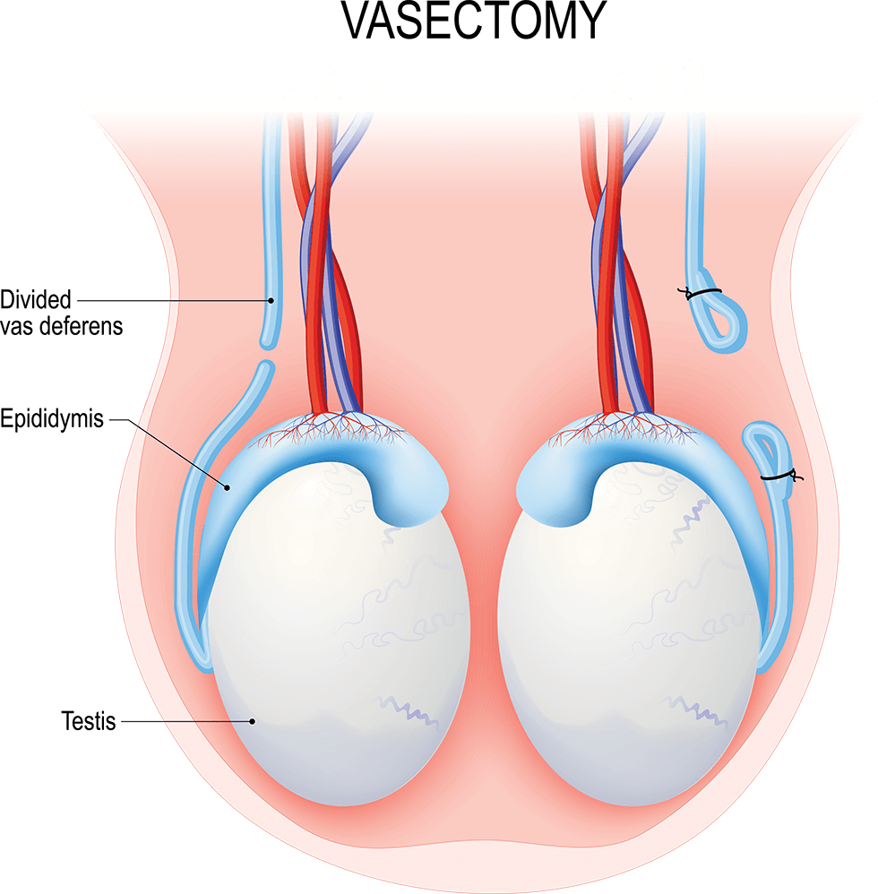 Illustration of vasectomy