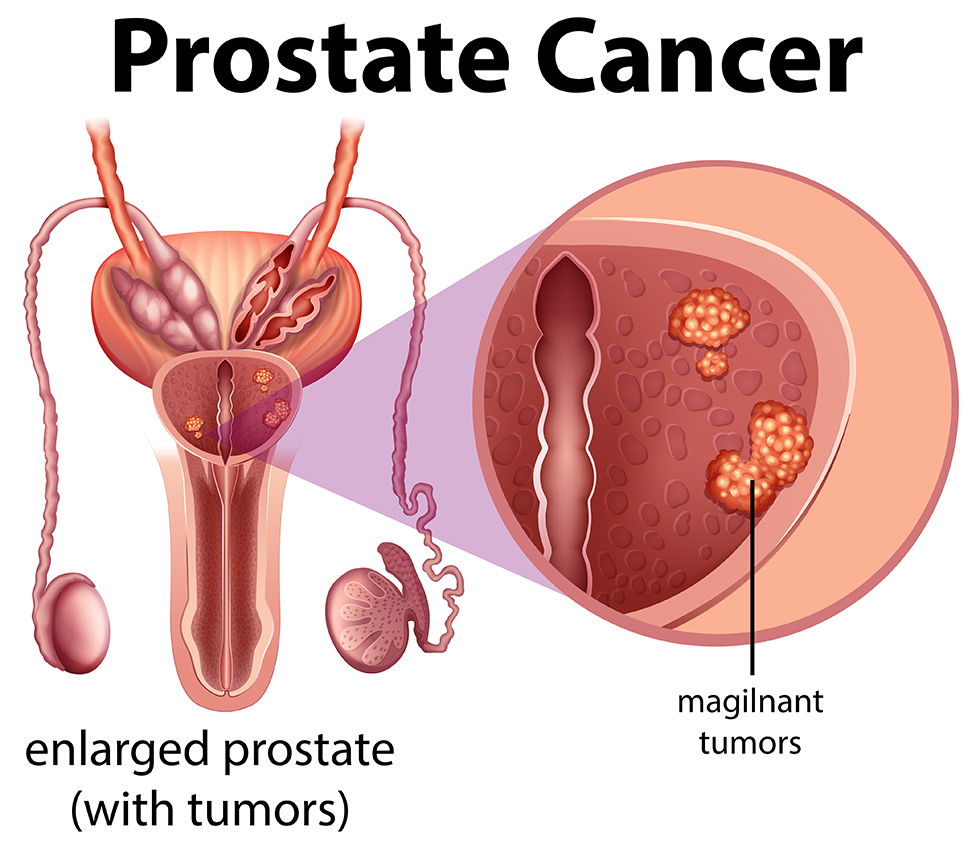 Illustration of prostate cancer in male anatomy