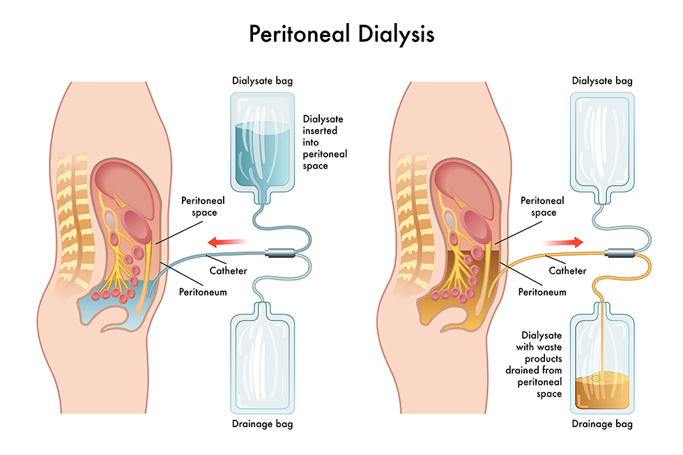 Vector medical illustration of peritoneal dialysis