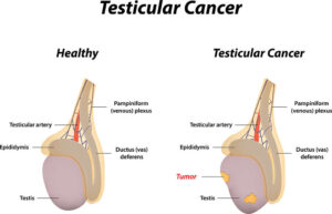 Illustration of testicular cancer