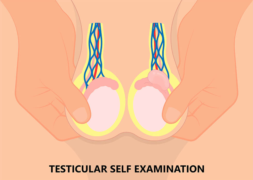 Illustration of testicular cancer self examination